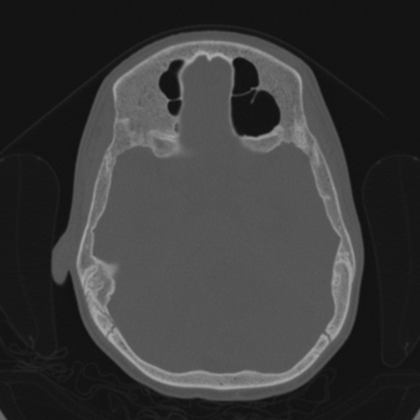 Cerebellar abscess secondary to mastoiditis (Radiopaedia 26284-26413 Axial bone window 82).jpg
