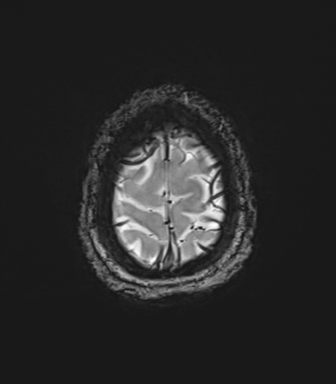 Cerebellar agenesis with hypoplastic pons (pontocerebellar hypoplasia) (Radiopaedia 57224-64138 Axial SWI 84).png