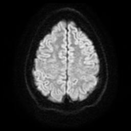 Cerebellar hemangioblastoma (Radiopaedia 29570-30077 Axial DWI 21).jpg