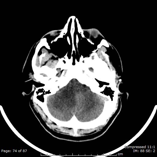 Cerebellar hemangioblastoma (Radiopaedia 52360-58258 Axial non-contrast 74).jpg