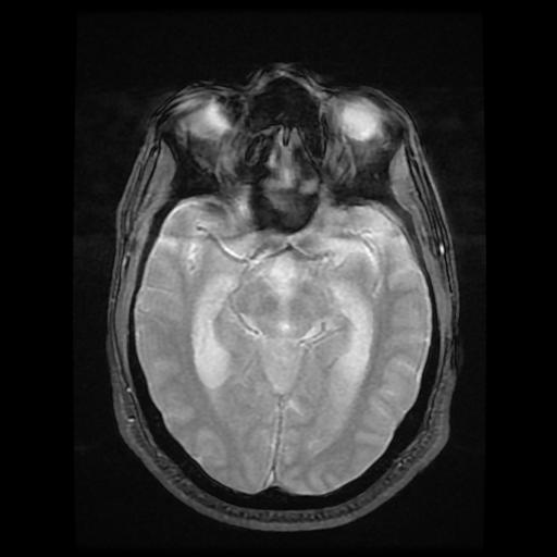 File:Cerebellar hemangioblastoma (Radiopaedia 88055-104622 Axial Gradient Echo 9).jpg