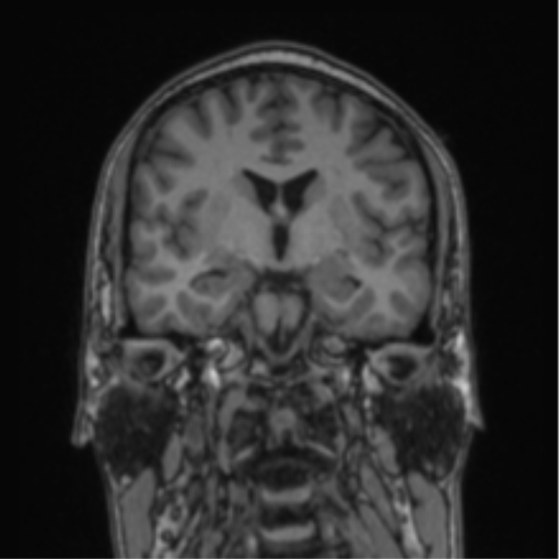 File:Cerebellar hemangioblastomas and pituitary adenoma (Radiopaedia 85490-101176 Coronal T1 51).png