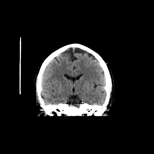 File:Cerebellar infarct due to vertebral artery dissection with posterior fossa decompression (Radiopaedia 82779-97032 Axial non-contrast 1).png
