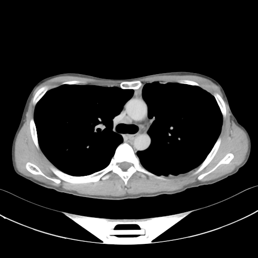 Cerebellar metastasis - adenocarcinoma lung (Radiopaedia 63184-71717 Axial C+ delayed 26).png