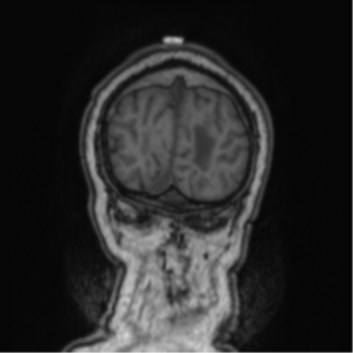 Cerebellar metastasis from lung adenocarcinoma (Radiopaedia 86690-102829 Coronal T1 11).png