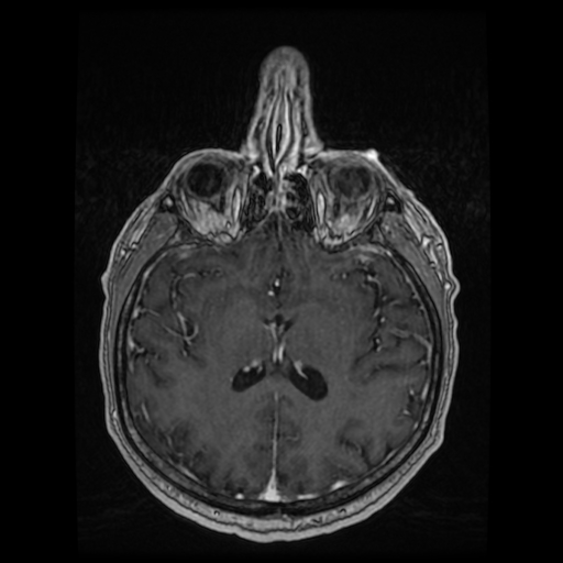Cerebellar metastasis of pulmonary adenocarcinoma, cavernous venous malformation, and developmental venous anomaly (Radiopaedia 85827-101661 Axial T1 C+ 56).jpg