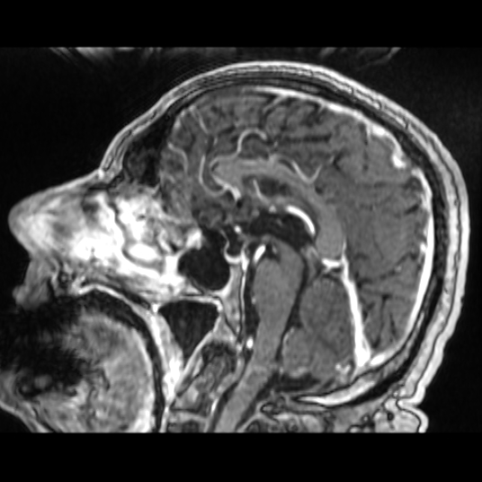 Cerebellar metastasis of pulmonary adenocarcinoma, cavernous venous malformation, and developmental venous anomaly (Radiopaedia 85827-101661 Sagittal T1 C+ 50).jpg