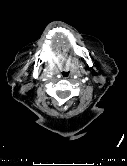 Cerebellar strokes due to intracranial giant cell arteritis (Radiopaedia 68799-78510 CT angiogram 93).jpg