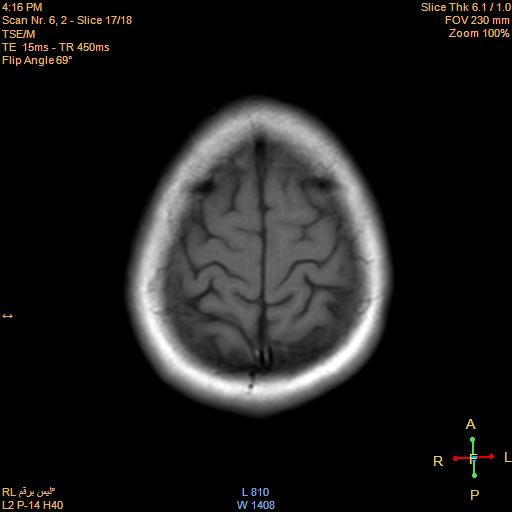 File:Cerebellopontine angle meningioma (Radiopaedia 22488-22525 Axial T1 16).jpg
