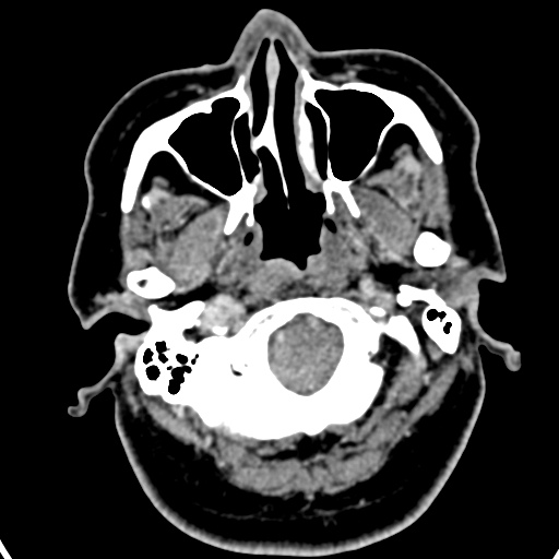 Cerebellopontine angle meningioma (Radiopaedia 35181-36714 A 53).jpg