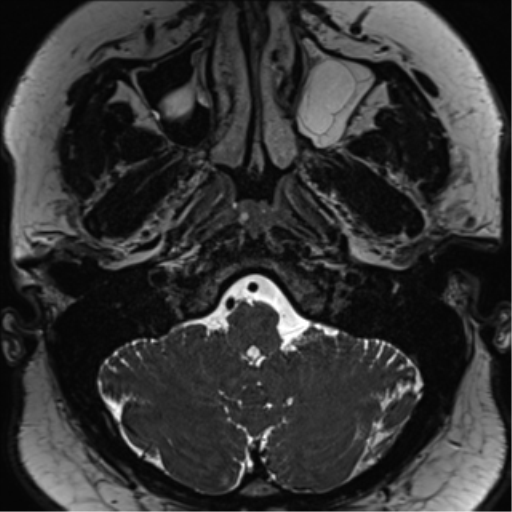 Cerebellopontine angle meningioma (Radiopaedia 48434-53348 Axial T2 Space 28).png