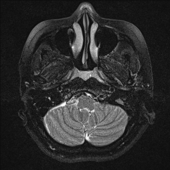 File:Cerebellopontine angle meningioma (Radiopaedia 53561-59591 Axial T2 fat sat 5).jpg