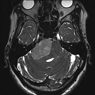 Cerebellopontine angle meningioma (Radiopaedia 72983-83680 Axial FIESTA 37).jpg