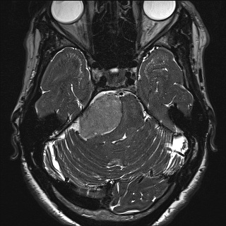 Cerebellopontine angle meningioma (Radiopaedia 72983-83680 Axial FIESTA 44).jpg