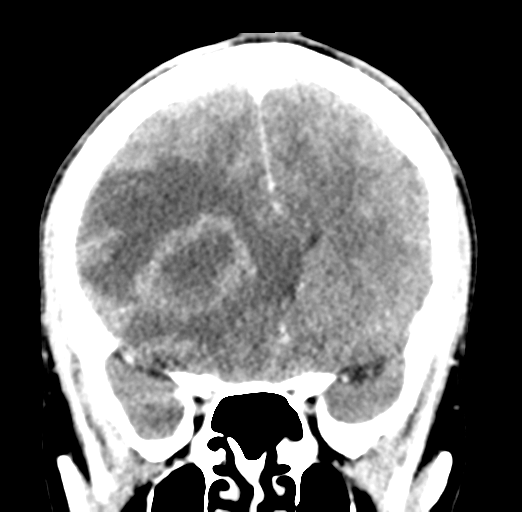 Cerebral abscess (Radiopaedia 60342-68008 Coronal C+ delayed 24).png
