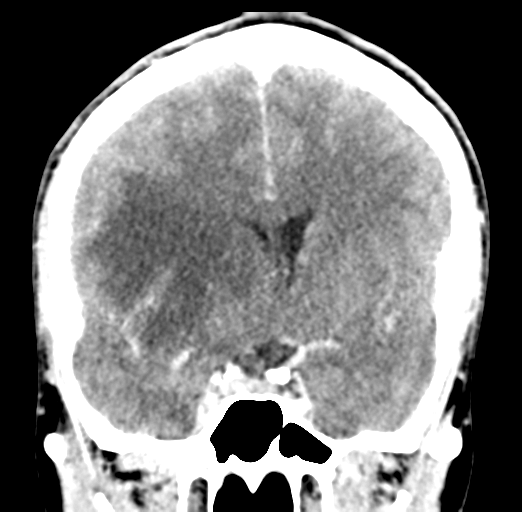 Cerebral abscess (Radiopaedia 60342-68008 Coronal C+ delayed 29).png