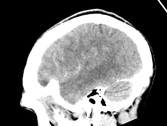 File:Cerebral abscess (Radiopaedia 60342-68008 Sagittal C+ delayed 11).png