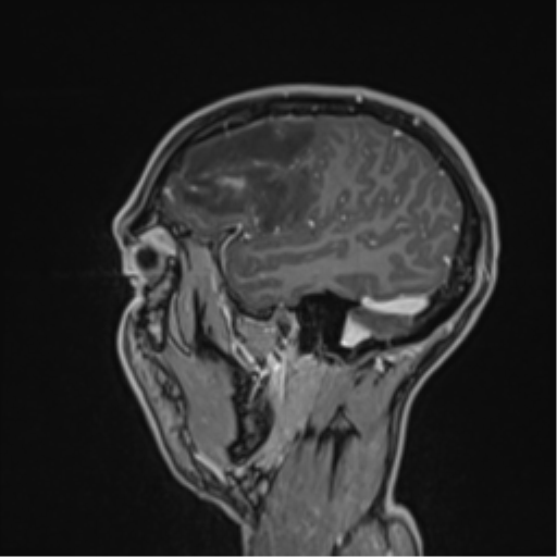 Cerebral abscess (Radiopaedia 60342-68009 J 45).png