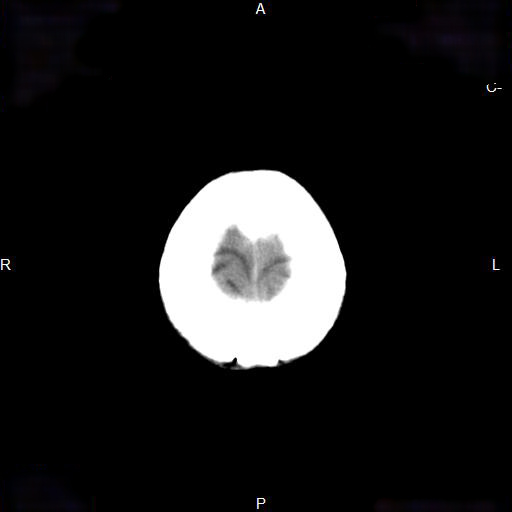 File:Cerebral abscess (Radiopaedia 7606-8431 Axial non-contrast 24).jpg