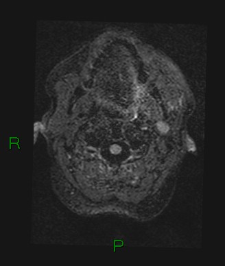Cerebral abscess and subdural empyema (Radiopaedia 84436-99779 Axial FLAIR 83).jpg