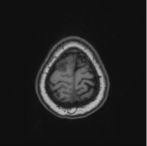 File:Cerebral abscess from pulmonary arteriovenous malformation (Radiopaedia 86275-102291 Axial T1 68).png