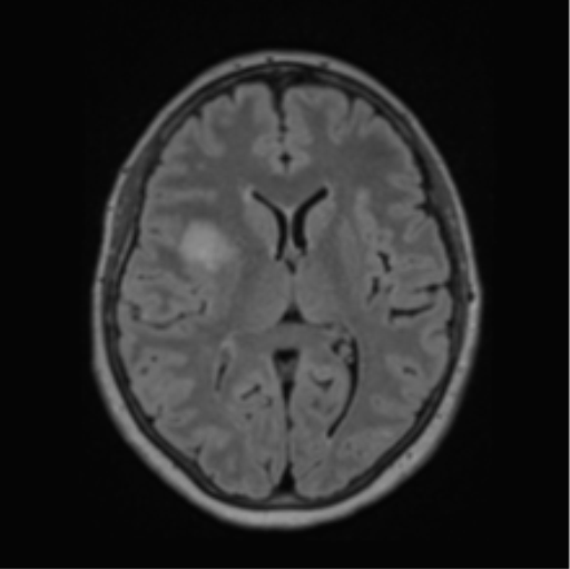 Cerebral abscess from pulmonary arteriovenous malformation (Radiopaedia 86275-102291 J 42).png
