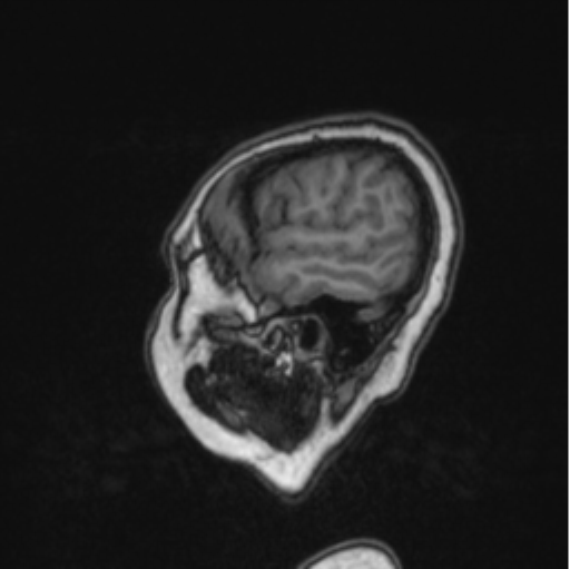 Cerebral abscess from pulmonary arteriovenous malformation (Radiopaedia 86275-102291 Sagittal T1 81).png