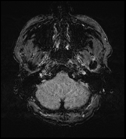 Cerebral abscess with ventriculitis (Radiopaedia 78965-91878 Axial SWI 9).jpg