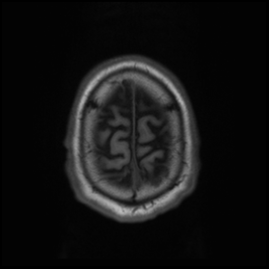 File:Cerebral abscess with ventriculitis (Radiopaedia 78965-91878 Axial T1 45).jpg