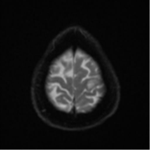 Cerebral abscesses- medically managed (Radiopaedia 45183-49179 Axial DWI 25).png