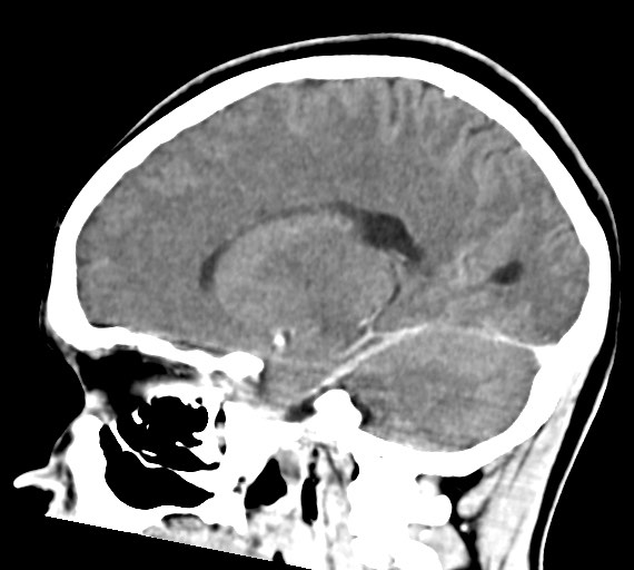 File:Cerebral abscesses (Radiopaedia 70458-80568 Sagittal Contrast 35).jpg
