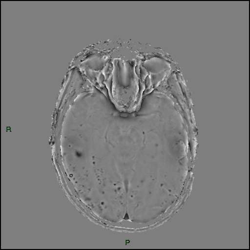 File:Cerebral amyloid angiopathy (Radiopaedia 77506-89664 H 44).jpg