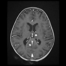 File:Cerebral and spinal tuberculosis (Radiopaedia 90489-107837 Axial T1 C+ 116).jpg
