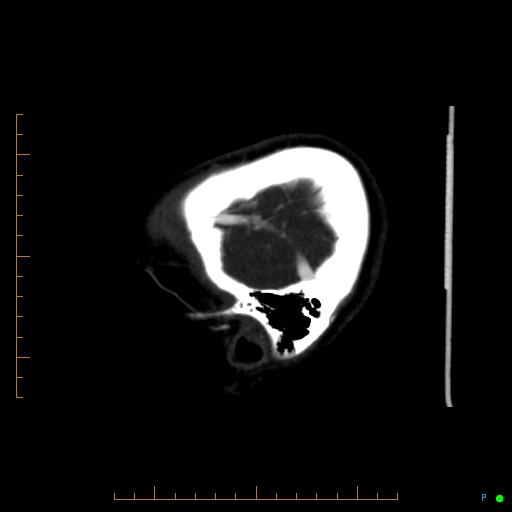 Cerebral arteriovenous malformation (AVM) (Radiopaedia 78162-90706 Sagittal CTA 10).jpg