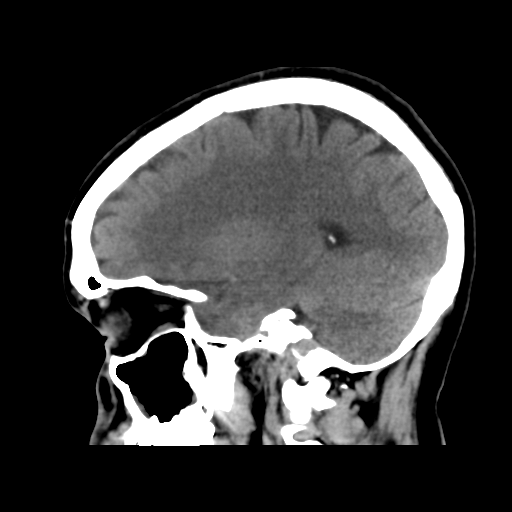 File:Cerebral arteriovenous malformation (Radiopaedia 39259-41505 B 24).png