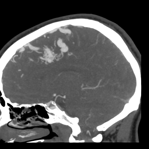 File:Cerebral arteriovenous malformation (Radiopaedia 39259-41505 Sagittal 28).png