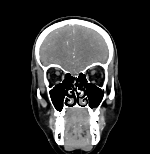Cerebral arteriovenous malformation (Radiopaedia 73830-84645 C 23).jpg