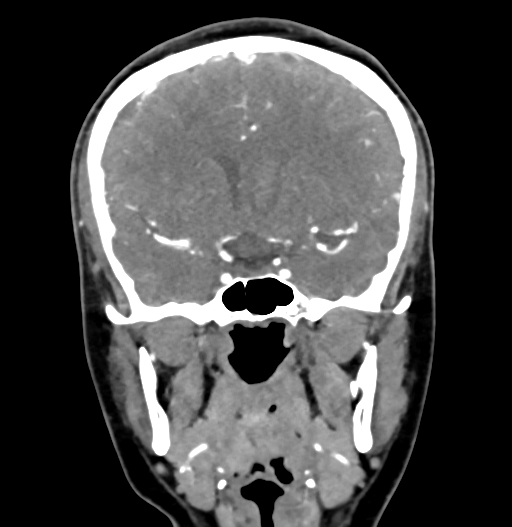 Cerebral arteriovenous malformation (Radiopaedia 73830-84645 C 42).jpg