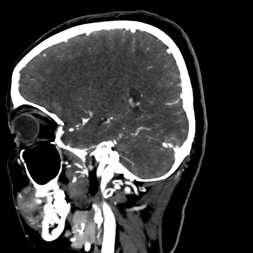 File:Cerebral arteriovenous malformation (Radiopaedia 73830-84645 Sagittal C+ delayed 30).jpg