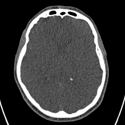 Cerebral arteriovenous malformation (Radiopaedia 78188-90746 Axial non-contrast 96).jpg