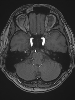 Cerebral arteriovenous malformation (Radiopaedia 84015-99245 Axial TOF 77).jpg