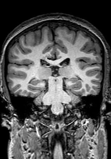 Cerebral arteriovenous malformation at posterior body of corpus callosum (Radiopaedia 74111-84925 Coronal T1 203).jpg