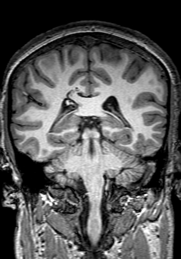 File:Cerebral arteriovenous malformation at posterior body of corpus callosum (Radiopaedia 74111-84925 Coronal T1 216).jpg