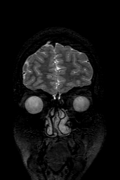 Cerebral arteriovenous malformation at posterior body of corpus callosum (Radiopaedia 74111-84925 Coronal T2 19).jpg