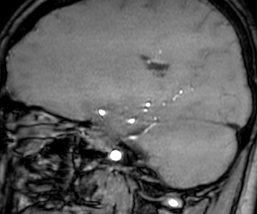 Cerebral arteriovenous malformation at posterior body of corpus callosum (Radiopaedia 74111-84925 J 142).jpg