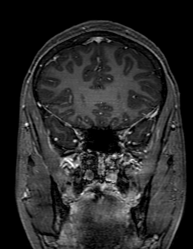 Cerebral arteriovenous malformation at posterior body of corpus callosum (Radiopaedia 74111-84925 K 101).jpg