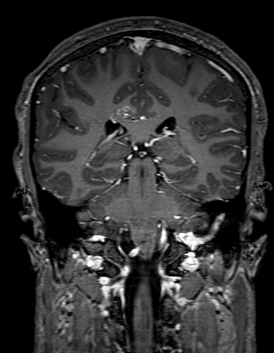 Cerebral arteriovenous malformation at posterior body of corpus callosum (Radiopaedia 74111-84925 K 230).jpg