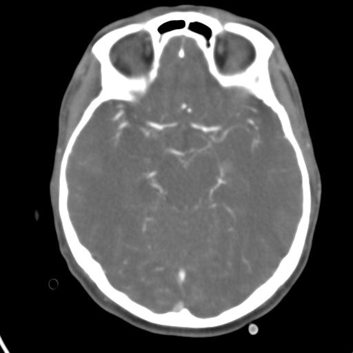 Cerebral arteriovenous malformation with hemorrhage (Radiopaedia 28773-29073 A 33).jpg