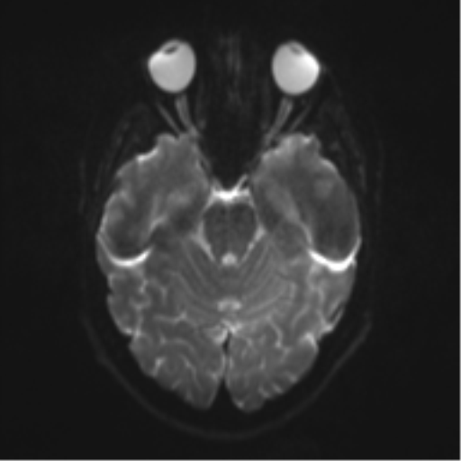 File:Cerebral cavernoma and development venous anomaly (Radiopaedia 37603-39482 Axial DWI 8).png