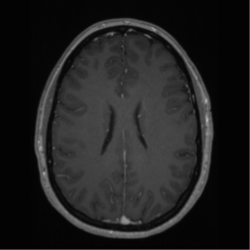 Cerebral cavernoma and development venous anomaly (Radiopaedia 37603-39482 Axial T1 C+ 48).png